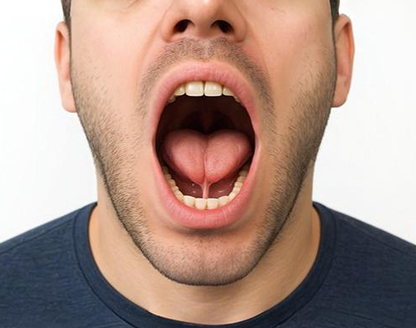 Frenum and Frenectomy: All You Should Know