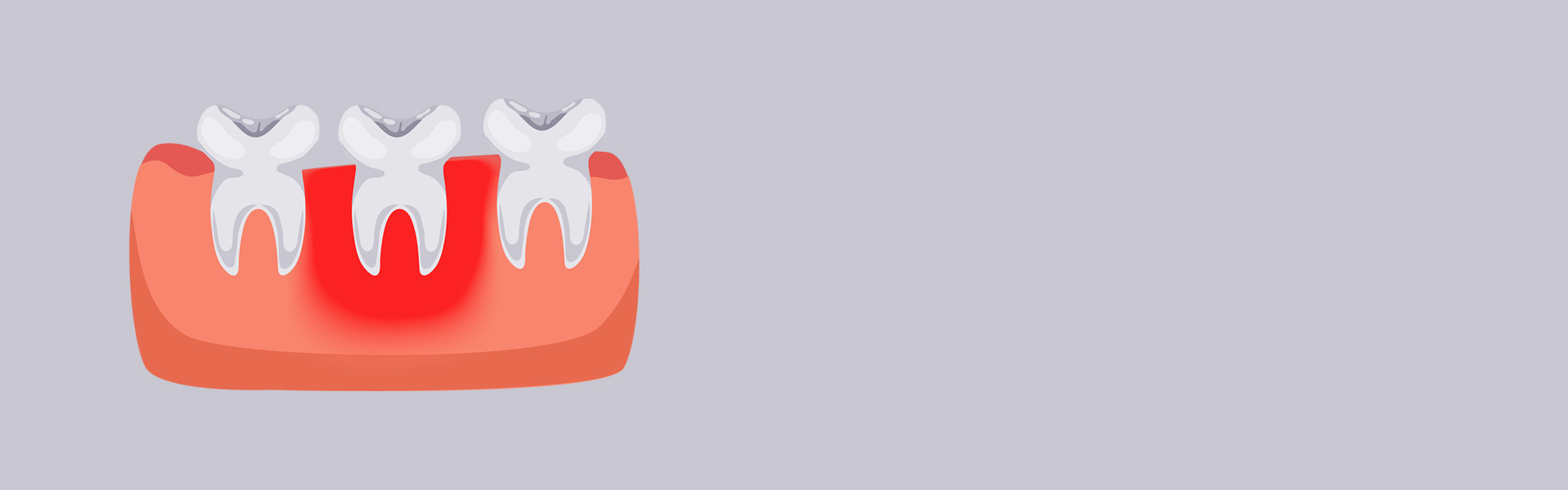 How Long Can You Keep Your Teeth With Periodontal Disease?