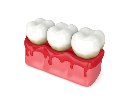 How Long Can You Keep Your Teeth With Periodontal Disease?