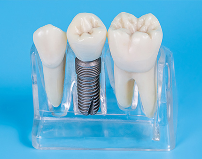 How Do Dental Implants Work?