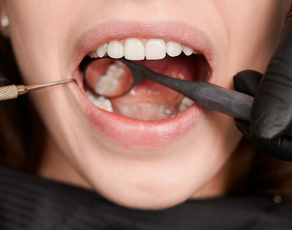 How Successful Are Pinhole Surgical Techniques for Gum Recession?