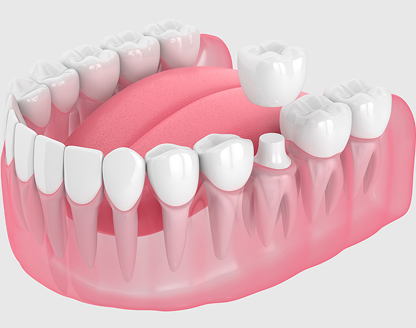 Can Dental Crowns Be Repaired or Replaced? Options for Damaged Crowns
