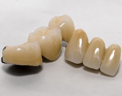 Can Dental Crowns Be Repaired or Replaced? Options for Damaged Crowns