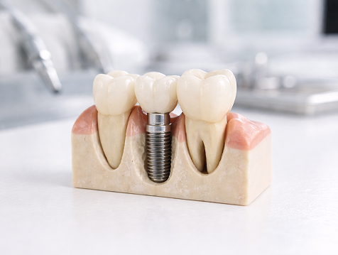 Dental Implant Model