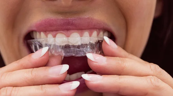 What to Eat (and Avoid) with Invisalign