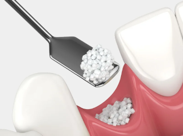 Bone Grafting and Dental Implants: Why It Matters