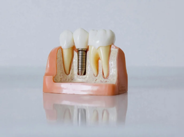 How to Care for Dental Implants to Help Them Last a Lifetime
